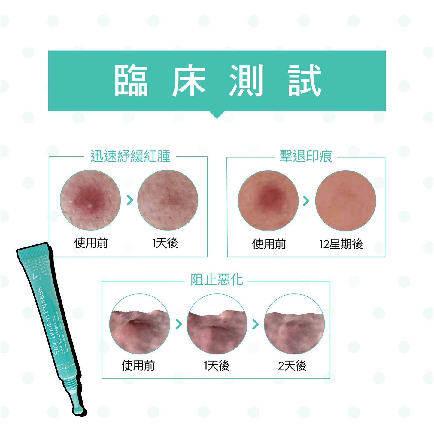 袪痘淡印收毛孔按摩筆 Express Blemish Care